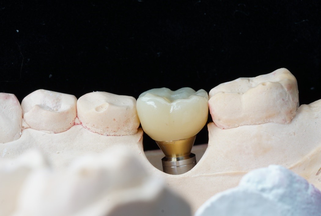 Dental Implant